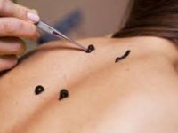 Гирудотерапияны қолдану аясы кеңейді